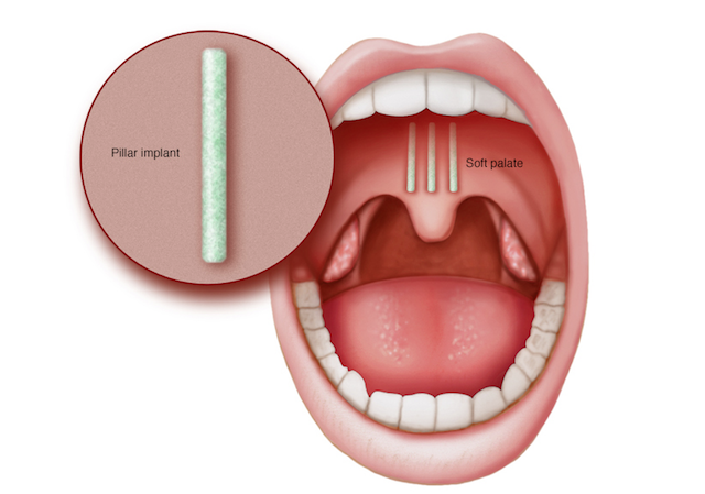 Pillar Procedure