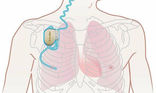 Upper Airway Stimulation