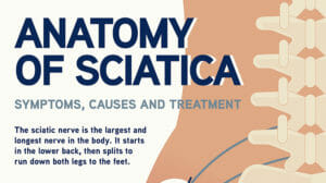 sciatica pain